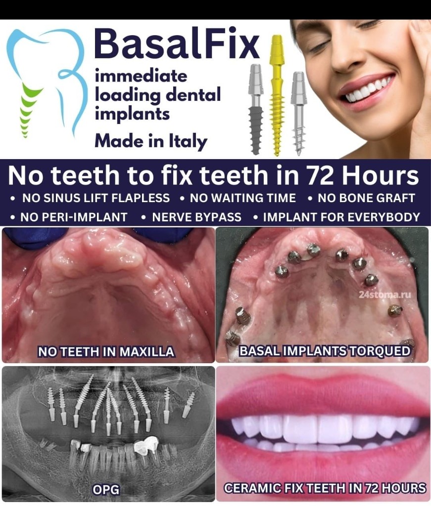 BasalFix Sofortbelastungs-Zahnimplantate - Made in Italy