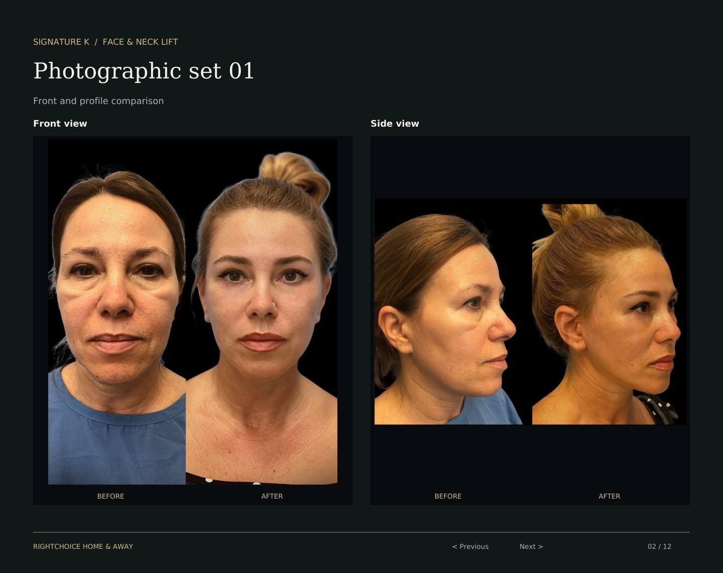 Signature K Face-and-Neck-Lift, fotografische Serie 01, Vorher und Nachher. Individuelle Ergebnisse variieren.
