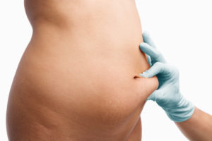 Tummy Tuck